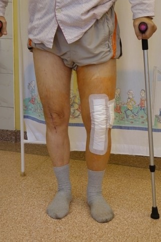 Pacjent po endoprotezoplastyce kolana